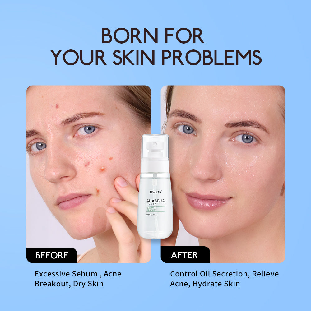 Aha Bha Face Toner Skin Care Spray Acne Treatment Moisturizing 110ml